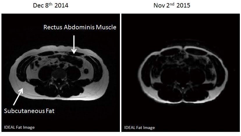 腰間脂肪減去10.3CM²